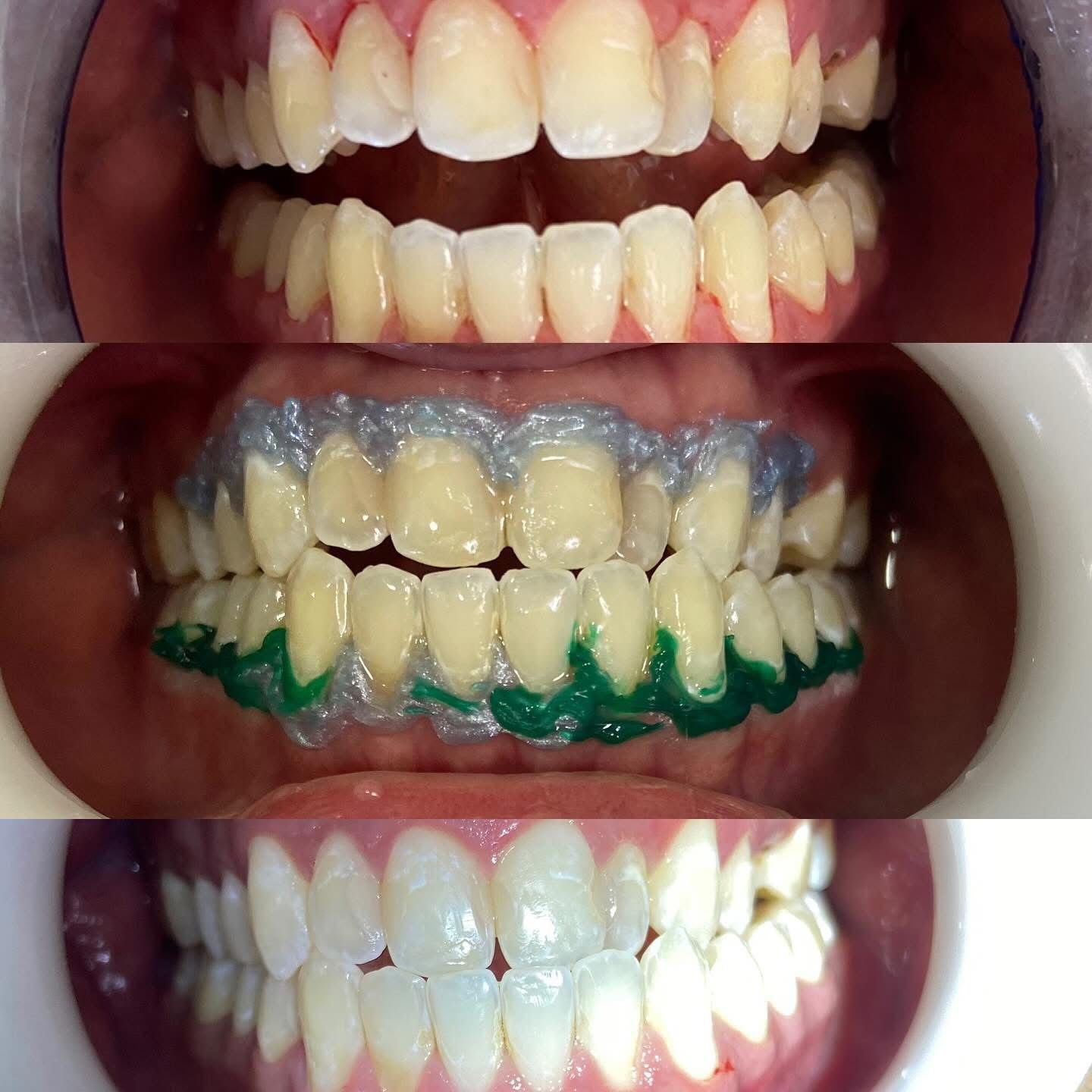 Clareamento Dentário