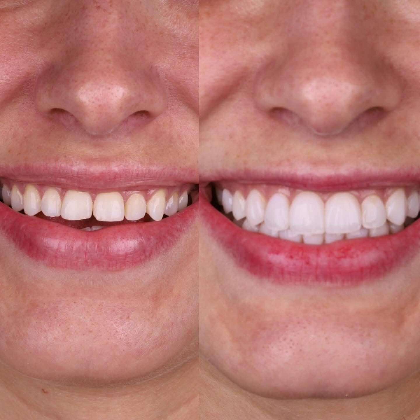 Facetas em Resina e Lentes